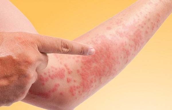 Da bị nổi sần và ngứa: nguyên nhân và cách điều trị