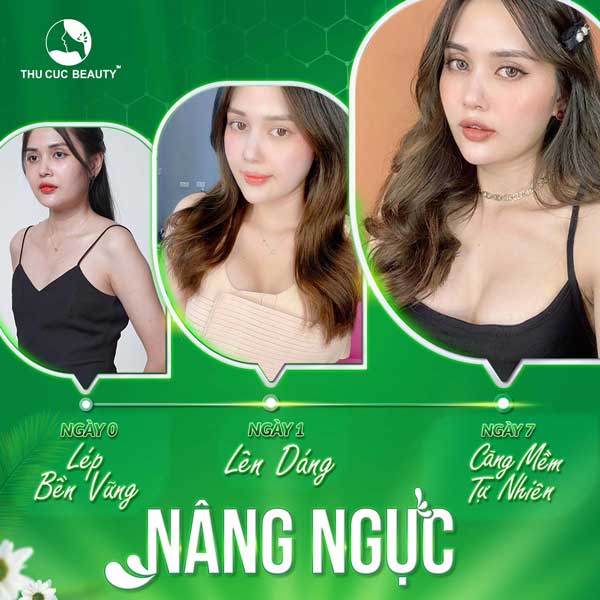 Nâng ngực có được vĩnh viễn không? - Thẩm mỹ Thu Cúc