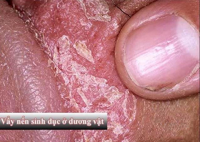 Bệnh vảy nến ở dương vật: Nguyên nhân, triệu chứng, cách điều trị tại nhà