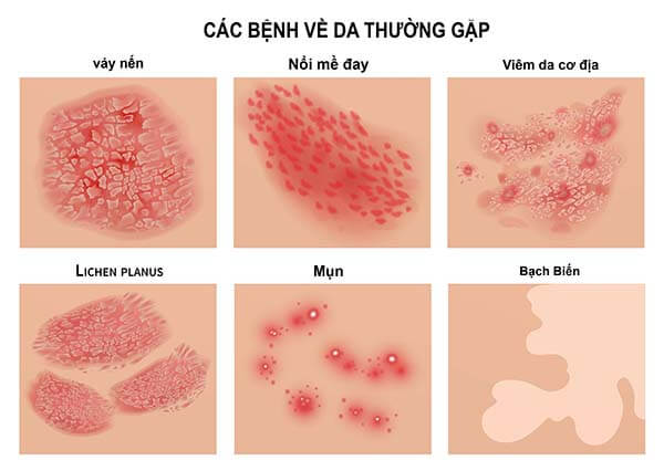 10+ bệnh da liễu thường gặp ở người lớn - cách điều trị hiệu quả