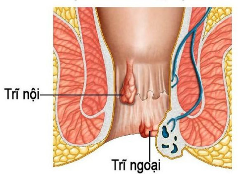 Những lưu ý cho người mắc bệnh trĩ giúp điều trị bệnh hiệu quả - Phòng Khám Đa Khoa An Giang
