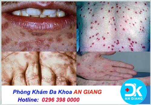 Bệnh giang mai lây lan bằng con đường nào?