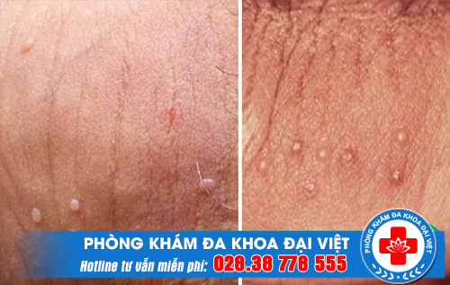Bác Sĩ Chuyên Khám Bệnh Sùi Mào Gà Uy Tín Tại Quận 12 - Phòng Khám Đa Khoa An Giang