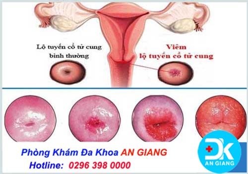 ✅Bị viêm lộ tuyến nên kiêng những gì? Phòng Khám Đa Khoa An Giang