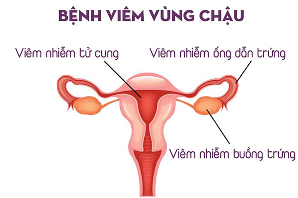 Viêm vùng chậu mãn tính có nguy hiểm không, cách điều trị ra sao? - Phòng Khám Đa Khoa An Giang
