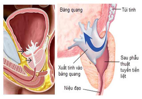 Xuất tinh ngược dòng: Nguyên nhân, tác hại và cách điều trị - Phòng Khám Đa Khoa An Giang