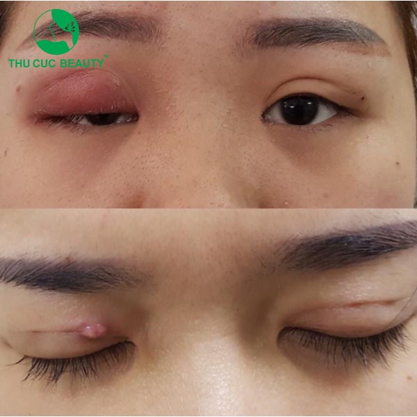 Tác hại của cắt mí mắt - Thu Cúc Sài Gòn