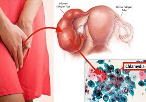 Hậu quả/tác hại nhiễm nấm Chlamydia - Phòng Khám Đa Khoa An Giang