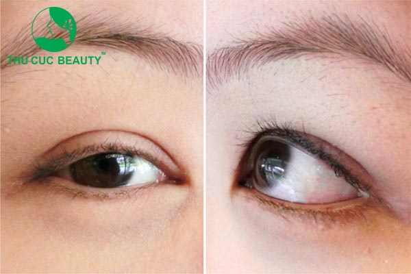 Cắt mí hỏng: Nguyên nhân và cách khắc phục - Thu Cúc Sài Gòn