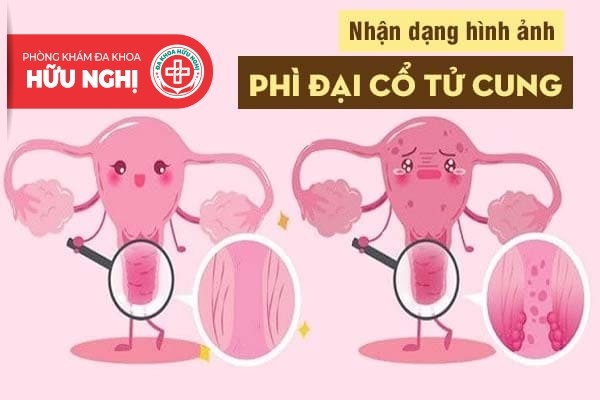 Nhận dạng hình ảnh phì đại cổ tử cung và cách chữa hiệu quả | Phòng Khám Đa Khoa An Giang