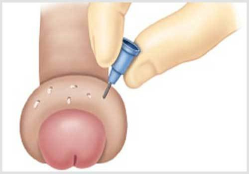 Cậu nhỏ bị sưng ngứa tấy đỏ sau khi quan hệ phải làm sao - Phòng Khám Đa Khoa An Giang