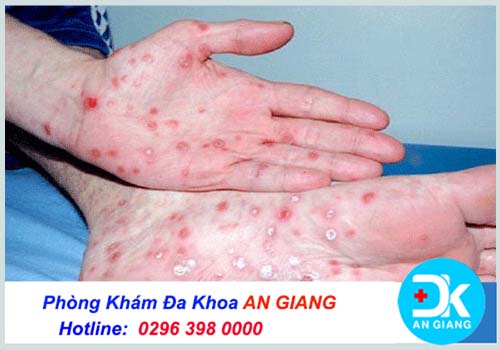 Các bệnh dễ nhầm với sùi mào gà ở nam và nữ - Phòng Khám Đa Khoa An Giang