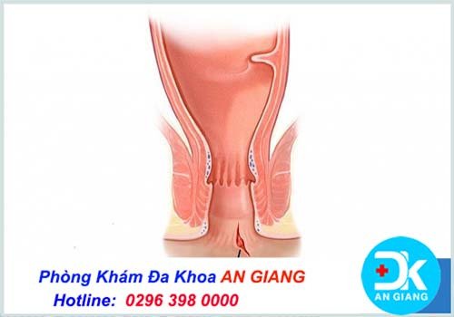 Top nguyên nhân dẫn đến nứt kẽ hậu môn có thể bạn chưa biết - Phòng Khám Đa Khoa An Giang