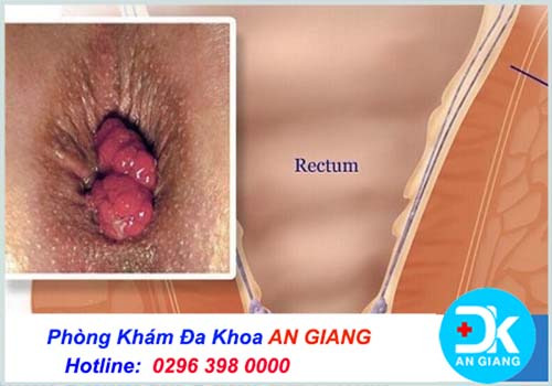 Lòi con trê là dấu hiệu của bệnh gì? Cách chữa trị - Phòng Khám Đa Khoa An Giang