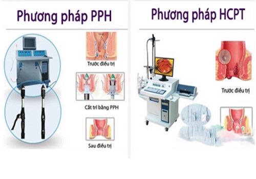 Phẫu thuật và mổ trĩ nội như thế nào? - Phòng Khám Đa Khoa An Giang