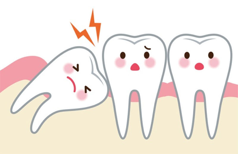 Nhổ nhiều răng khôn cùng một lúc có sao không?