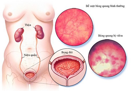 Phương pháp điều trị viêm bàng quang xuất huyết - Phòng Khám Đa Khoa An Giang