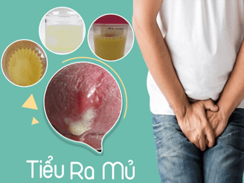 Địa chỉ chữa tiểu buốt - tiểu mủ uy tín tại An Giang