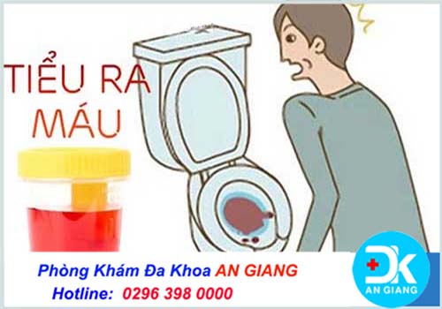 ✅Nguyên nhân đi tiểu ra máu là gì? Phòng Khám Đa Khoa An Giang