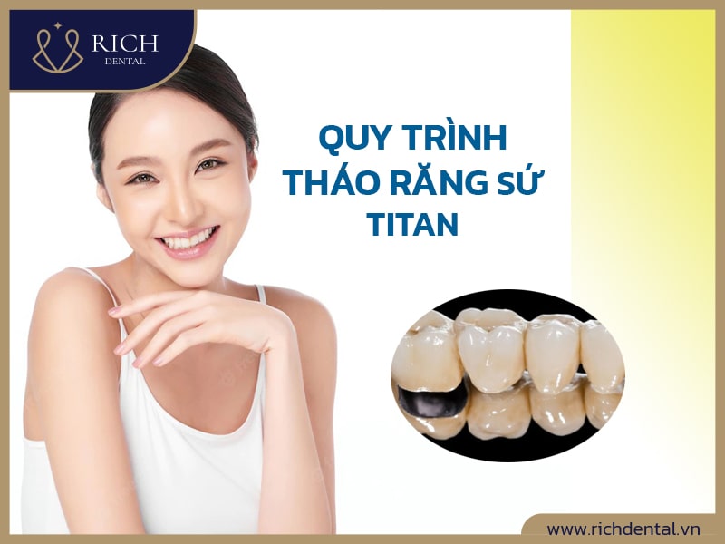 Quy Trình Tháo Răng Sứ Titan Chuyên Nghiệp Tại Rich Dental