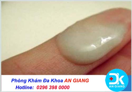 Khí hư có màu xanh là triệu chứng bệnh gì?