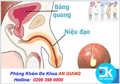 Tiểu buốt có mủ là biểu hiện của bệnh nguy hiểm nào? | Phòng Khám Đa Khoa An Giang