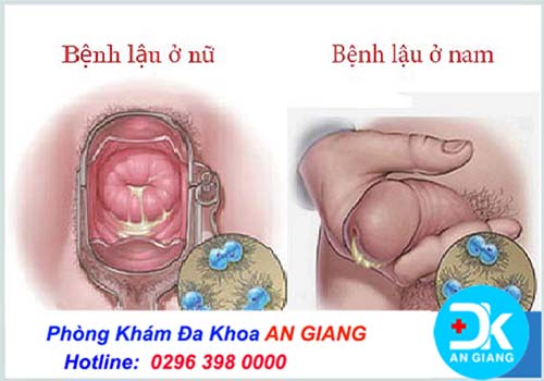 ✅Chữa trị bệnh lậu tại nhà được không ? Phòng Khám Đa Khoa An Giang