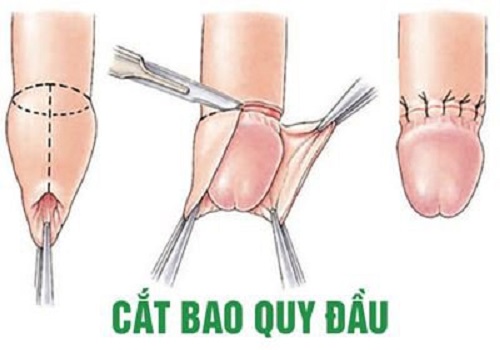 Nong/Cắt bao quy đầu bao lâu thì lành? - Phòng Khám Đa Khoa An Giang