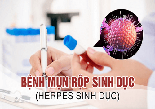 Địa chỉ chữa mụn rộp sinh dục uy tín tại Bến Tre