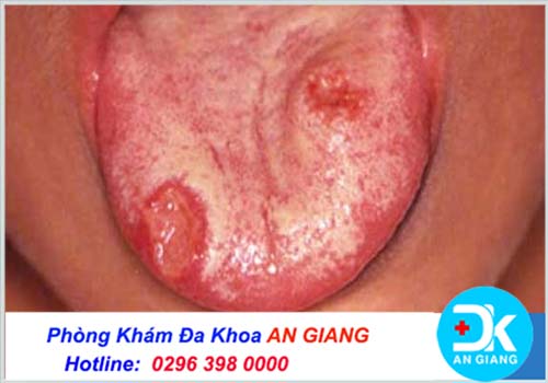 Nhận biết dấu hiệu ban đầu của bệnh giang mai