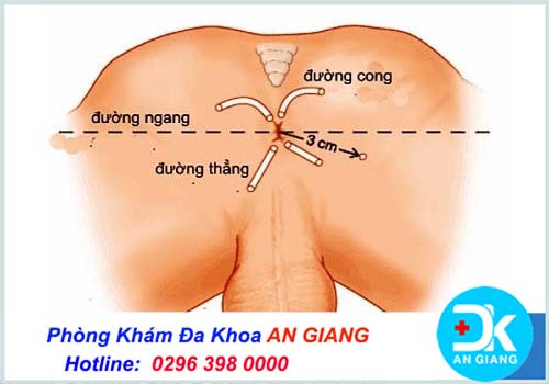 Những biến chứng sau mổ rò hậu môn mà bạn nên biết - Phòng Khám Đa Khoa An Giang