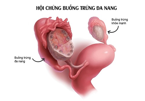 Địa chỉ chữa buồng trứng đa nang uy tín tại An Giang