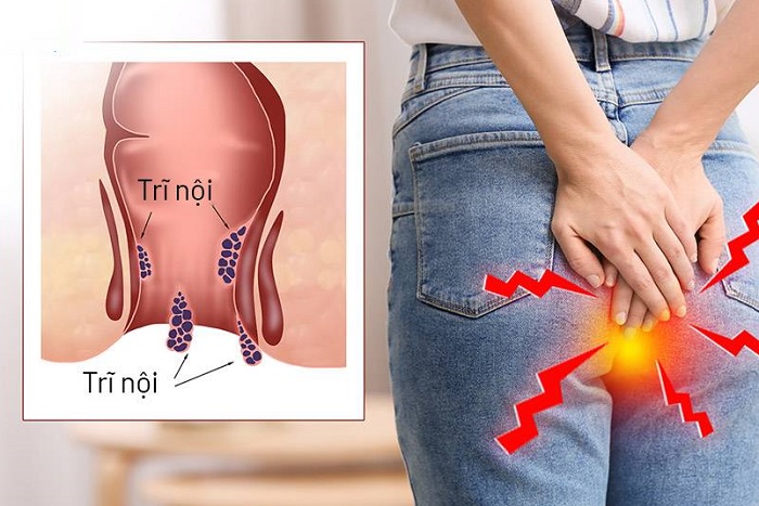 Địa chỉ chữa bệnh trĩ uy tín tại Tiền Giang