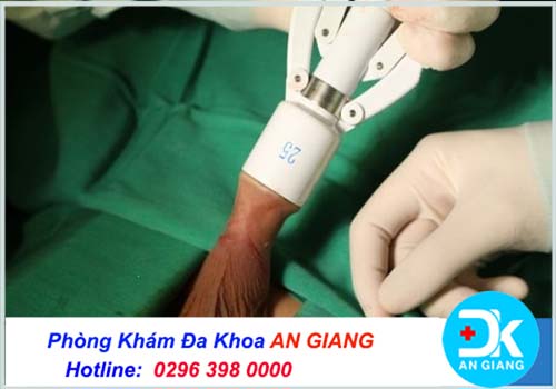 Cắt bao quy đầu bằng laser là phương pháp gì? Có an toàn không? | Phòng Khám Đa Khoa An Giang