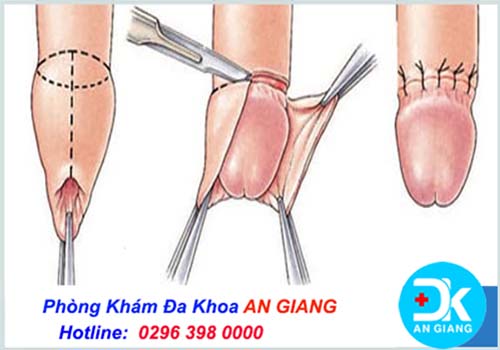 Tiến hành cắt bao quy đầu có đau không ?