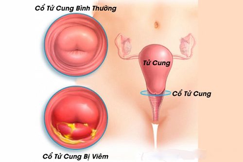#Địa chỉ chữa bệnh viêm cổ tử cung uy tín tại Tiền Giang - Phòng Khám Nam Khoa An Giang