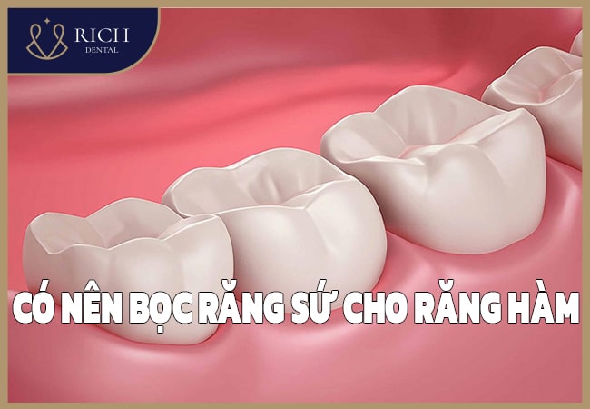 Có Nên Bọc Răng Sứ Cho Răng Hàm Không? Loại Nào Tốt Nhất Hiện Nay?