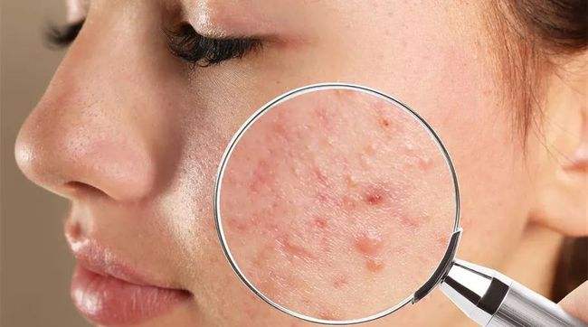 Mụn trứng cá là gì ? Phác đồ điều trị mụn trứng cá ra sao ?