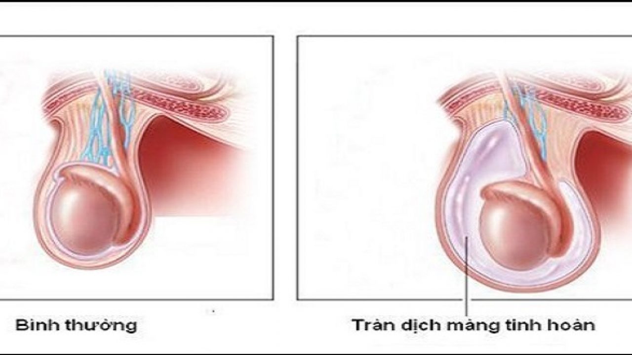 Viêm tinh hoàn tràn dịch là gì? Nguy hiểm không? Chữa thế nào?