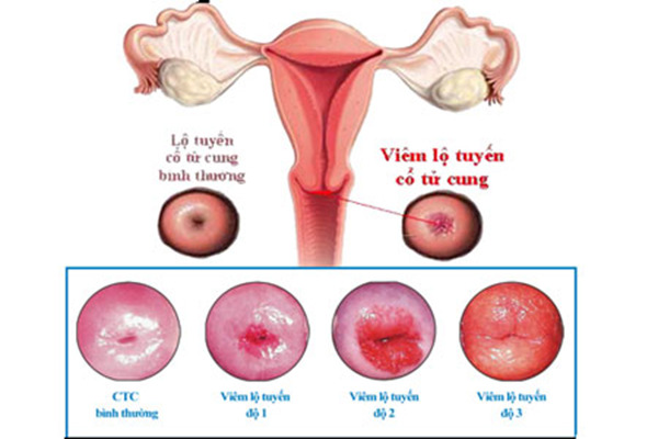 địa chỉ chữa viêm lộ tuyến cổ tử cung uy tín tại Hậu Giang