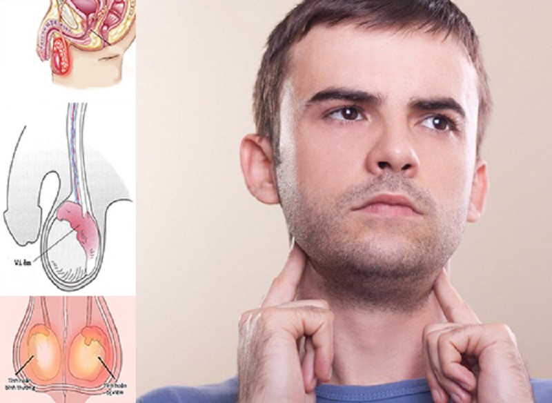 Nguy cơ viêm tinh hoàn quai bị & cách điều trị hiệu quả nhất