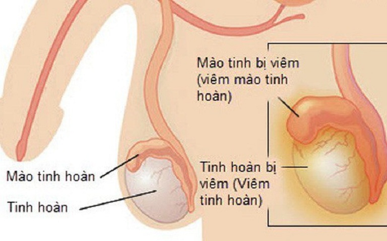 [Cảnh báo] – Nguy hiểm khi bị viêm mào tinh hoàn