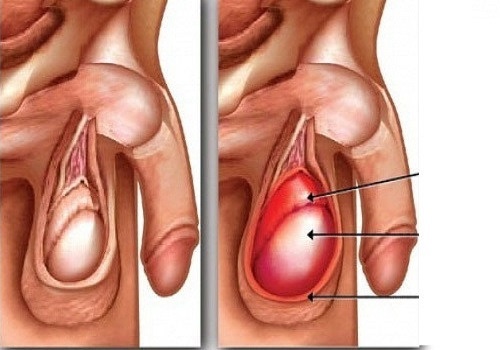 Bệnh viêm tinh hoàn ở nam giới có nguy hiểm không? - Phòng Khám Đa Khoa An Giang