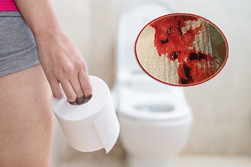 #Địa chỉ chữa đi đại tiện ra máu tươi uy tín tại Tiền Giang - Phòng Khám Nam Khoa An Giang
