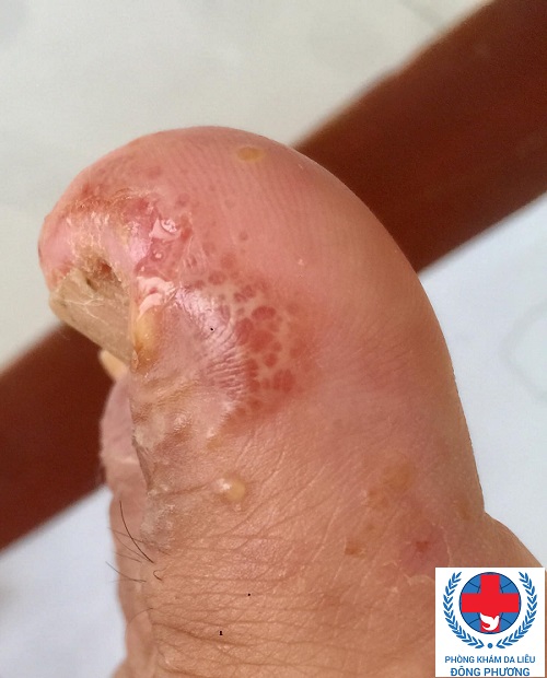 Tay nổi mụn nước là bệnh gì?