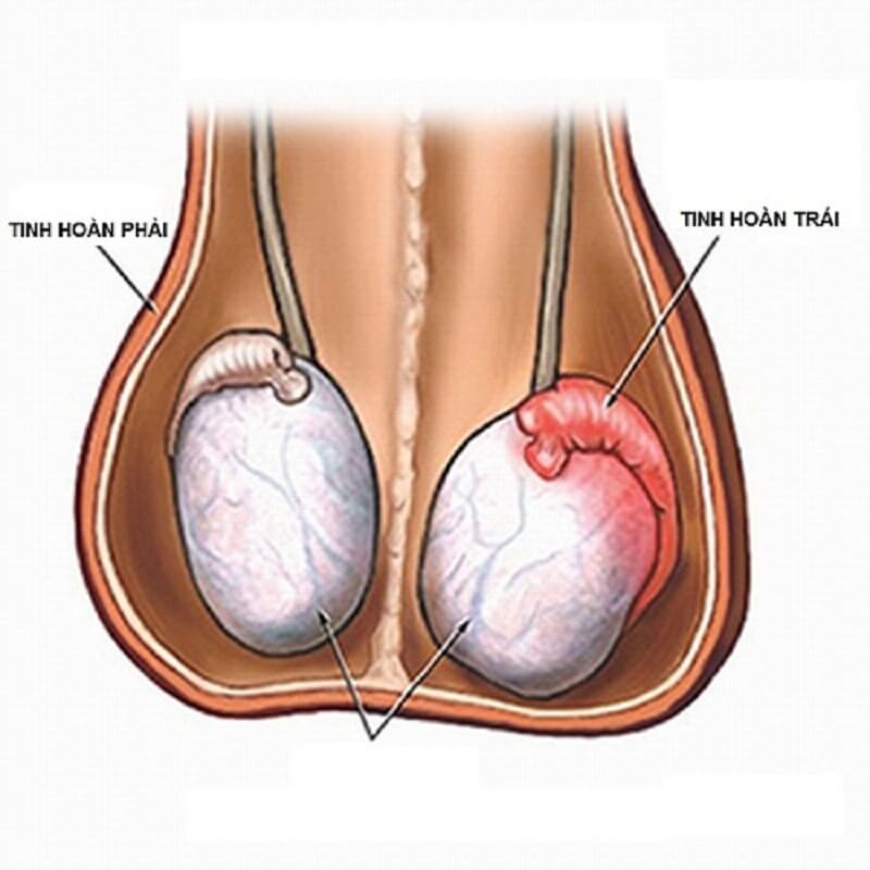 [Cảnh báo] Nguy hiểm khi đau ở tinh hoàn trái!