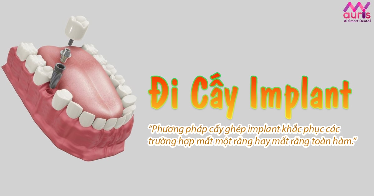 Kinh nghiệm khi đi cấy implant như thế nào? - Nha Khoa My Auris