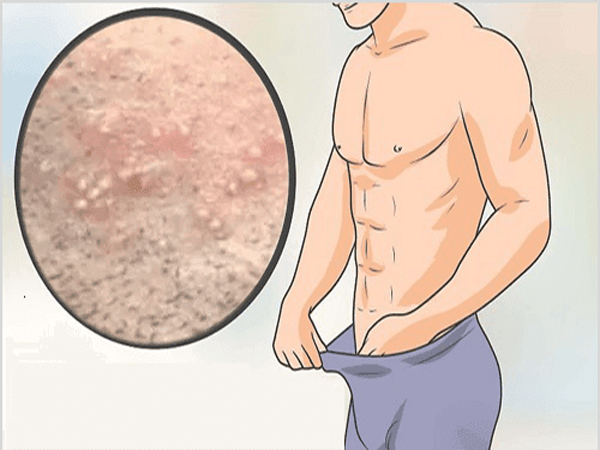 Nổi mụn ở đầu dương vật: Nguyên nhân và cách điều trị hiệu quả