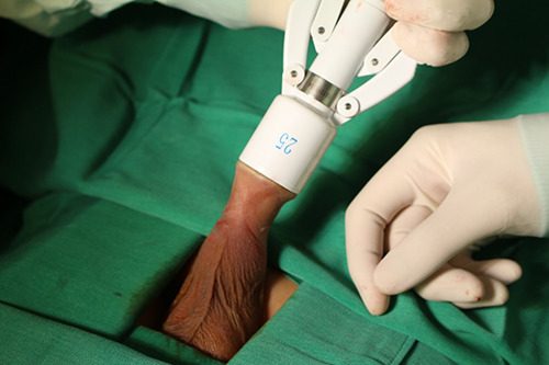 ✲Địa chỉ cắt bao quy đầu uy tín tại Hậu Giang