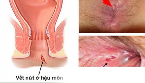 #Địa chỉ chữa nứt kẽ hậu môn uy tín tại Tiền Giang - Phòng Khám Nam Khoa An Giang